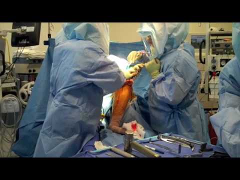 stryker total knee replacement pdf