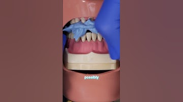 Relined Bite Method - Full Arch Prep