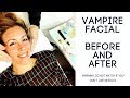 Vampire Facial Review  - Microneedling With PRP Results