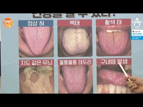 내 혀의 색이 &amp;#39;황색&amp;amp;백색&amp;#39;이라면?! 이런 &amp;#39;건강 질환&amp;#39;을 의심해라! | 행복한 아침 228 회