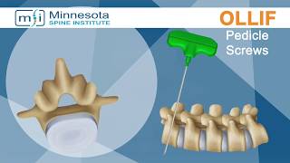 Minimally Invasive Oblique Lateral Lumbar Interbody Fusion (OLLIF) @  the Minnesota Spine Institute
