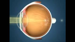 What is Astigmatism?