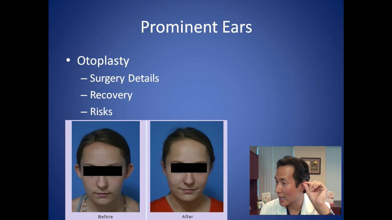how to fix ears that stick out how to fix ears that stick out
