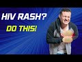 How long does an HIV rash last ?