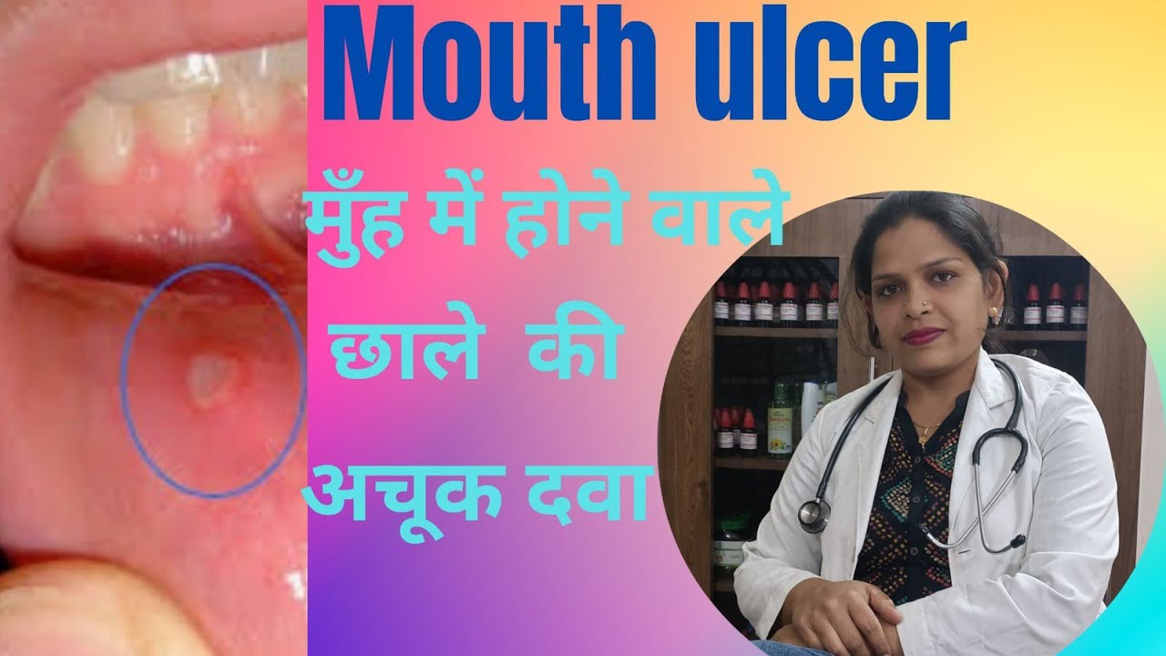 Mouth ulcer! Homeopathy medicine for mouth ulcer?? reccurent mouth