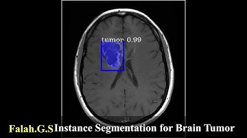 Instance Segmentation System for Human Brain Tumor using Mask R-CNN algorithm