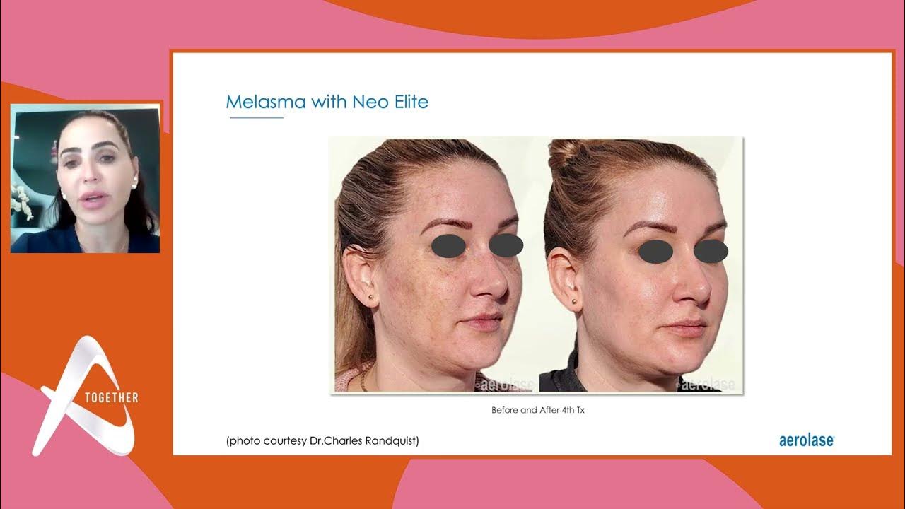 Dr. Roberta Del Campo Aerolase for my clients at Aesthetics 2023