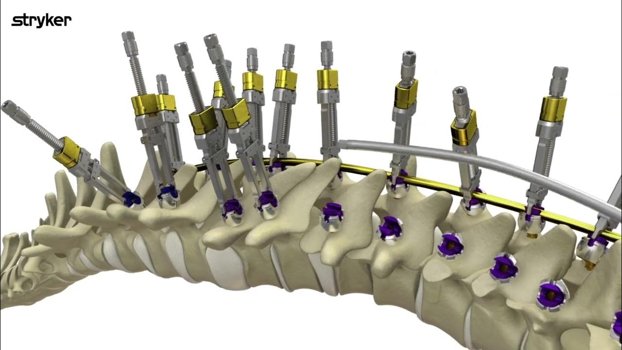 Alkan Medical Stryker Introduce DDC Technique YouTube