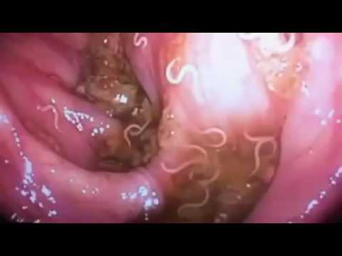 stomach worms inside human