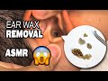 👂⛏️😱 EAR WAX REMOVAL ASMR 😩 his ears are finally FREE and CLEAR of all that CHEESY JUNK 🧀🧀🤮