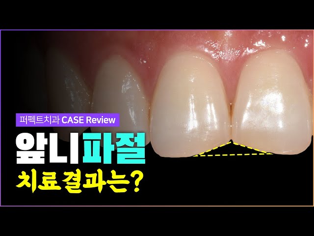 앞니 파절 0.1~0.2mm 폴리네이트 | 치아다듬기