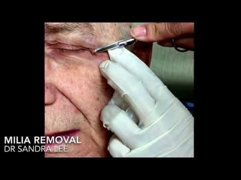 Milia Removal Compilation + Extras.  For Medical Education- NSFE.