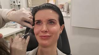 Botox And Injectables With Sari Katz, Pa-C Of Schweiger Dermatology In Nyc Part 2