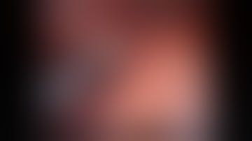 Bronchopulmonary sequestration treated by Da Vinci robotic resection