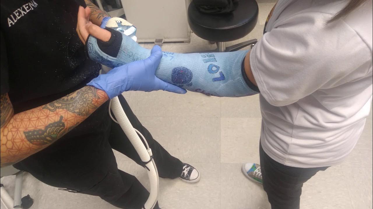 How To Remove Long Arm Cast / Cast Cut Off YouTube