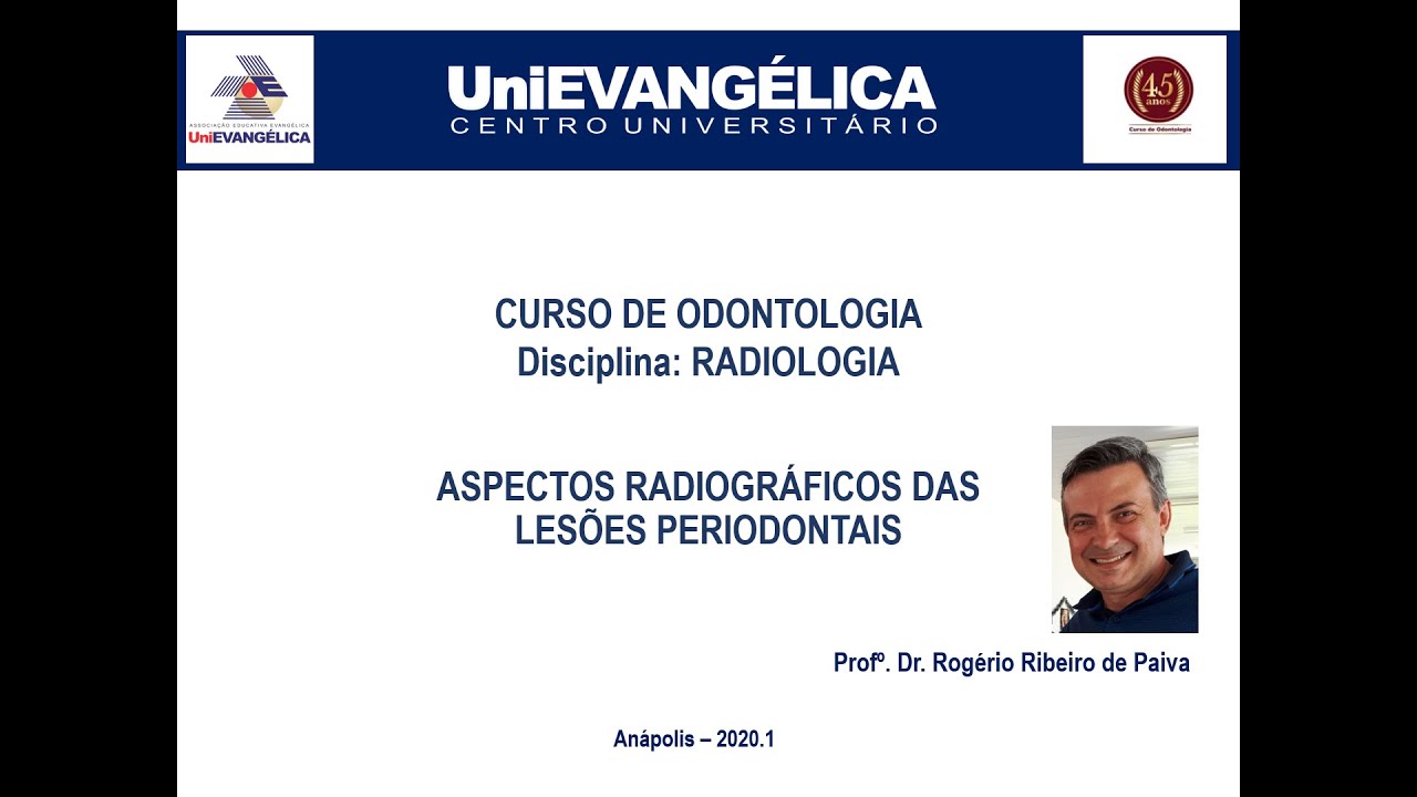 AULA 4 - ASPECTOS RADIOGRÁFICOS DAS LESÕES PERIODONTAIS / PROF. ROGÉRIO PAIVA