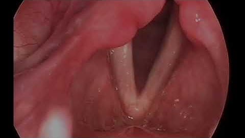 Stroboscope/laryngoscopy of normal vocal cords