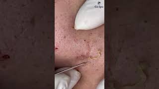 Opening the beginning of the week with a video of a customer&#39;s acne squeezing at #gaspa clinic #acne