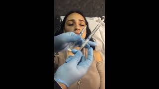 Dr Verduzco, Lips inyection Juvederm, Tijuana