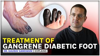 GANGRENE | DIABETIC FOOT | LEG PAIN | Peripheral angioplasty | Dr. Gaurav Gangwani