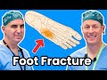 How to treat your broken foot jones and fifth metatarsal fractures