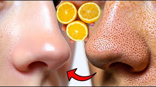Do this and blackheads on your nose will disappear forever Works like magic