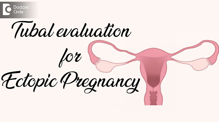 What are the chances of ectopic pregnancy after tubal ligation