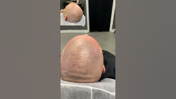 Scalp micropigmentation after first session