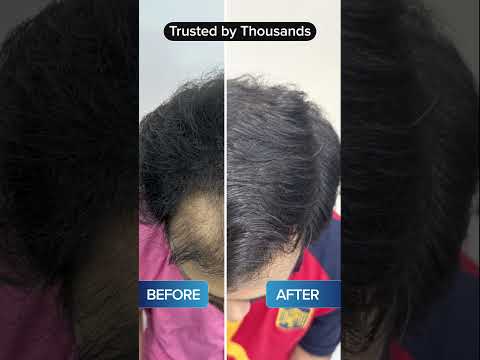 Hair transplant transformation video 6