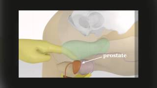 Massage De La Prostate