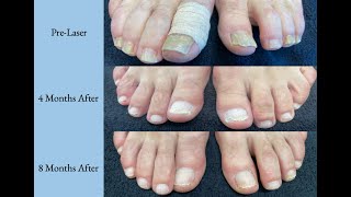 Dramatic Change in Nails With Laser Treatment