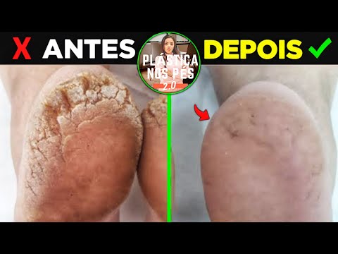 ➡ A VERDADE | Treinamento Plástica mais Spa dos pés 2021 Reclame aqui! é Seguro Confiável? Hotmart!