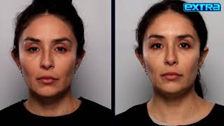 Fight Sagging and Wrinkles with Skin-Tightening Sofwave Treatment screenshot 3