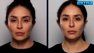 Celebrity Fight Sagging and Wrinkles with Skin-Tightening Sofwave Treatment Wealth
