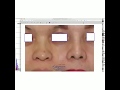 Post operasi plastik hidung. 3 bulan. Rhinoplasty case.