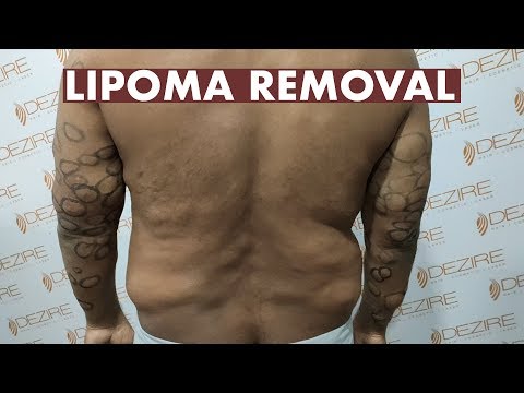 Video: Finns Det En Lipoma Botemedel?