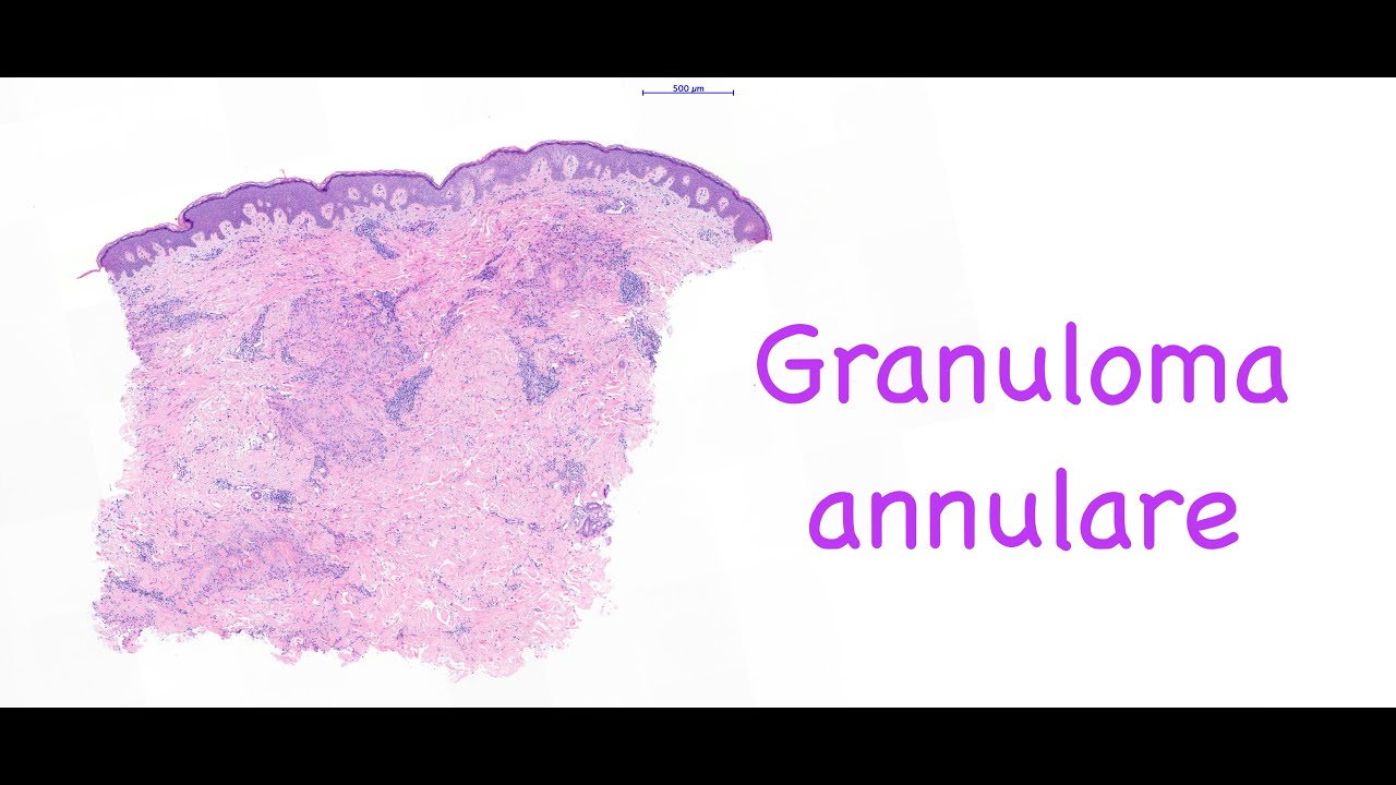 Granuloma Annulare