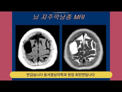 뇌 지주막낭종MRI