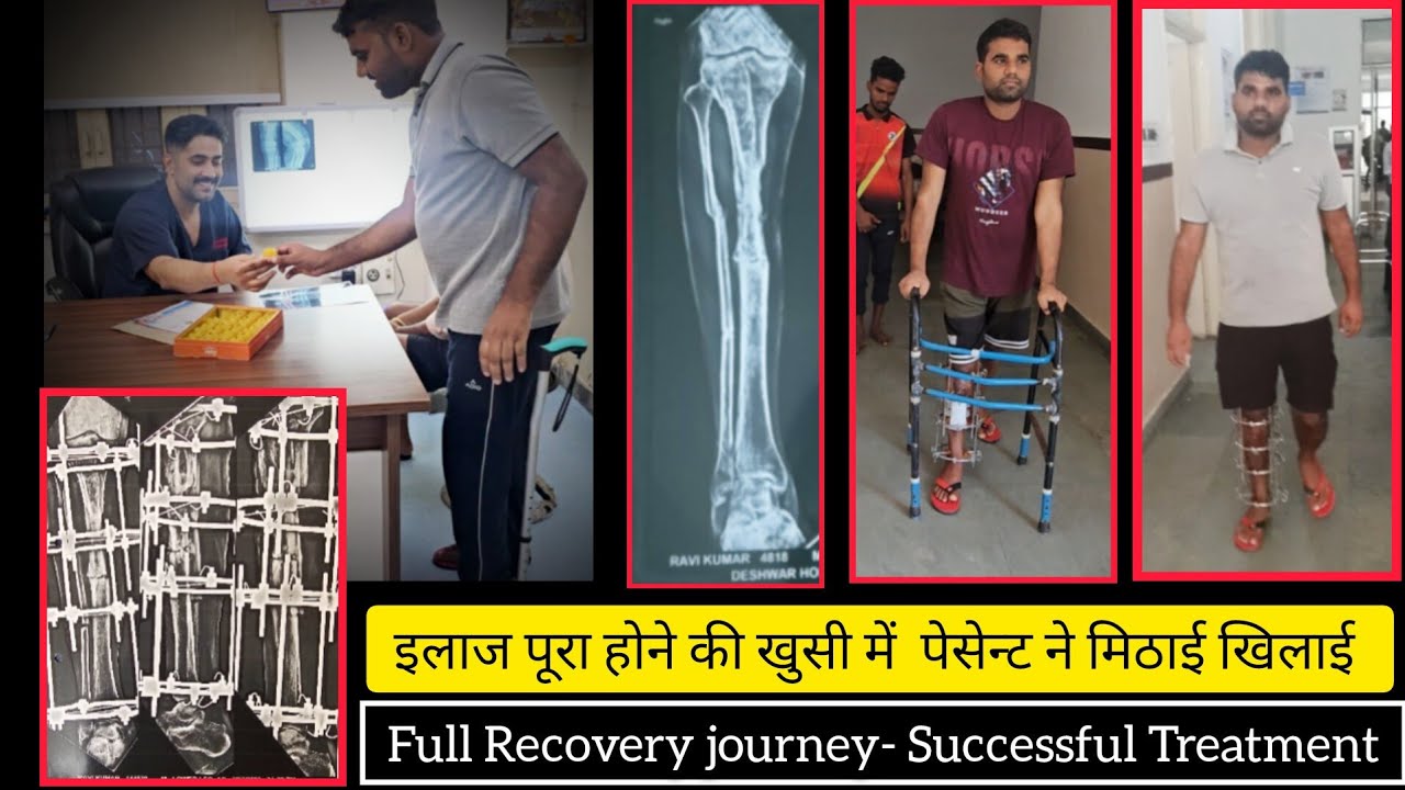 Операция Илизарова — успешное лечение несросшегося перелома большеберцовой кости 