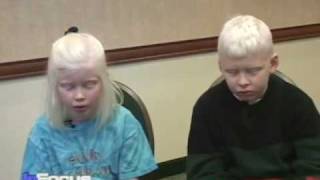 African Albinos on VOA's In Focus screenshot 4