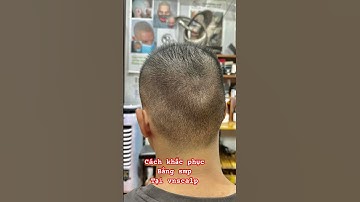 Cấy tóc có để lại sẹo, cấy tóc thành công , cấy tóc để lại sẹo quanh đầu #xămtóc