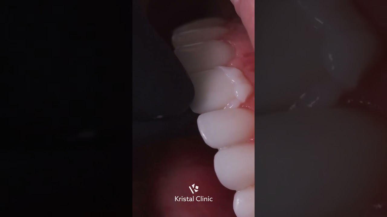 "The Secret to a Perfect Hollywood Smile"