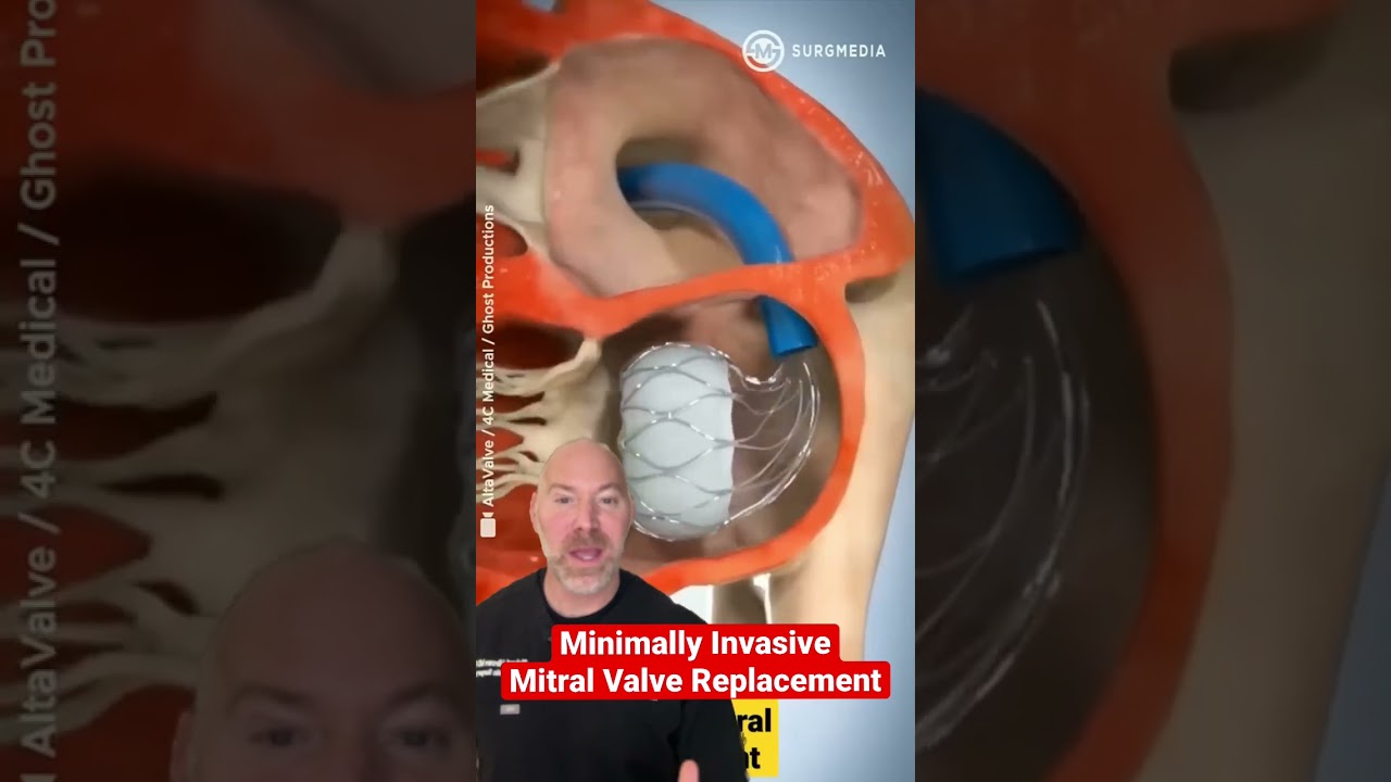 Replacing a Heart Valve 🫀 
