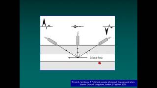 Doppler Features, Pitfalls and Artifacts
