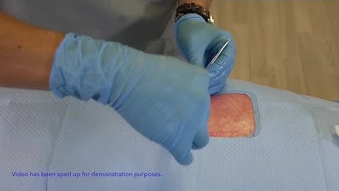 Spinal Cord Stimulator Pocket Closure with the V-Loc™ Wound Closure Device - Dr. Yeshvant Navalgund