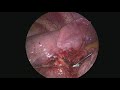 11minute vats right lower lobe lobectomy nonedited