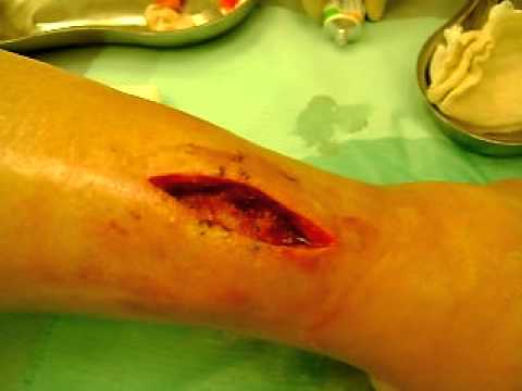 Перевязка раны голени