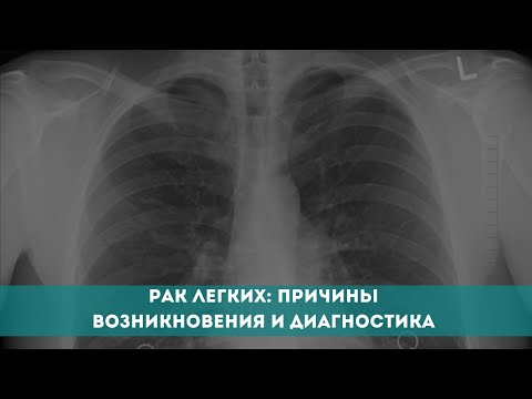 Рак легких: причины