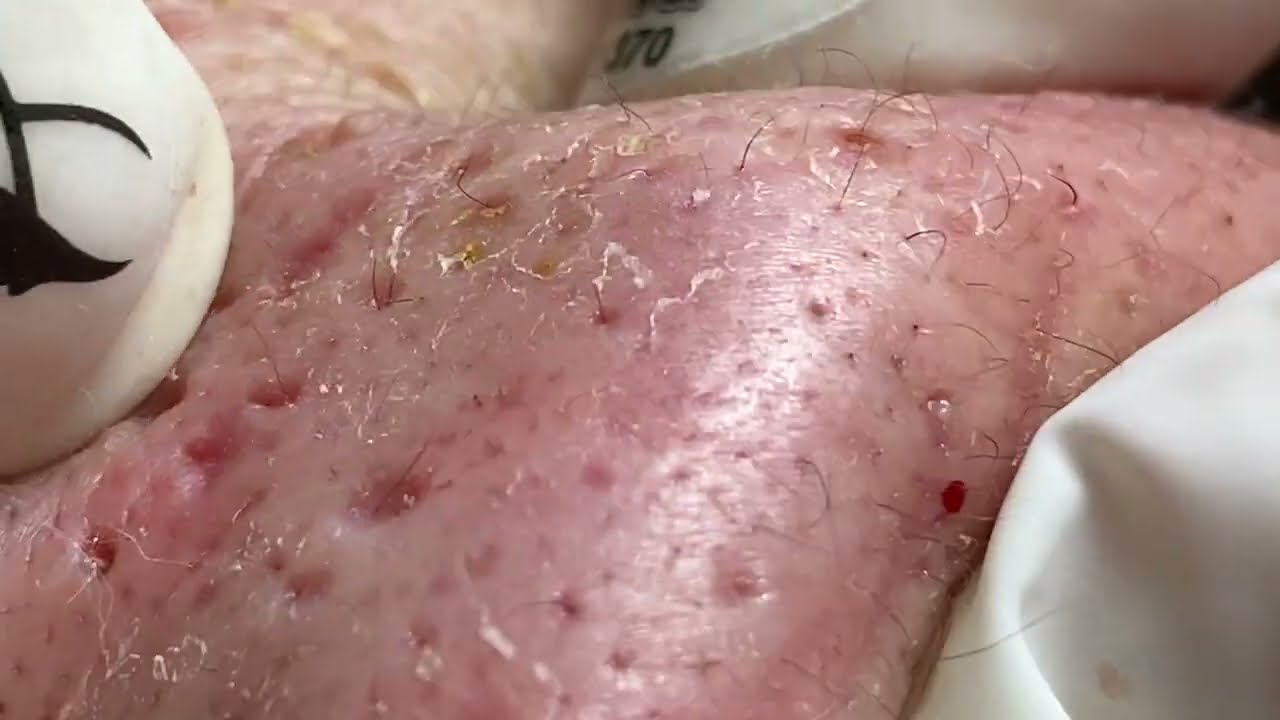 Sweet Little Bacne Blackhead!