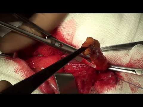 Видео: Ингвинална херния - симптоми, лечение, операция за отстраняване на ингвинална херния